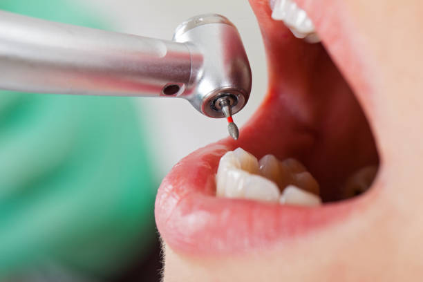 Best Emergency Treatment for Oral Infections in East St Louis, IL